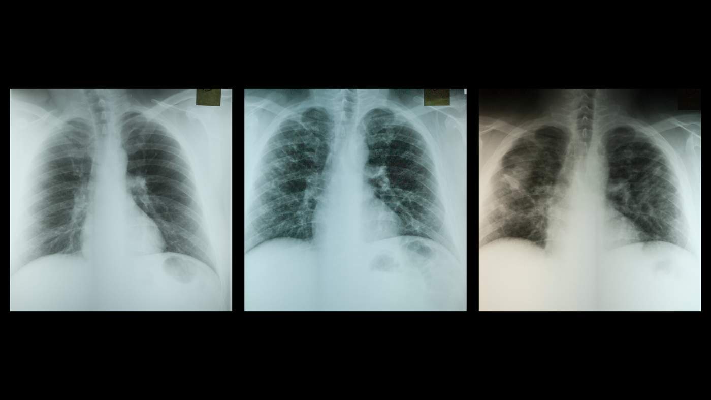 Chest x-rays showing the progression of CWP in a US coal worker from 1991 (normal X-ray) to 2000 (X-ray shows PMF). Fibrosis is shown by white lines and masses on the X-rays. The patient died in 2004 at the age of 45 from respiratory failure secondary to CWP with PMF. (Images courtesy of Edward L Petsonk, MD, Professor of Medicine, West Virginia University School of Medicine.)