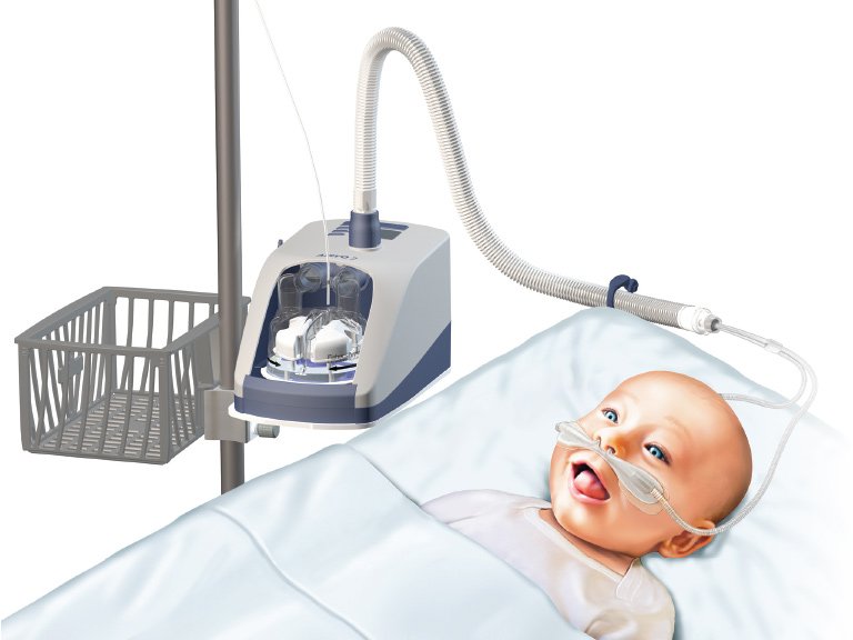 Babies With Bronchiolitis Benefit From New Oxygen Therapy UQ News   Hi Flow 